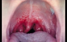 Damakta Aft Belirtileri ve Tedavisi