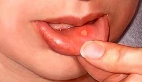 Oral Aft Belirtileri ve Tedavisi