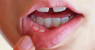 Ağız İçi Aft Belirtileri ve Tedavisi