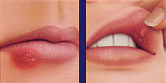 Aft İlacı Kullanımı ve Faydaları Nelerdir?