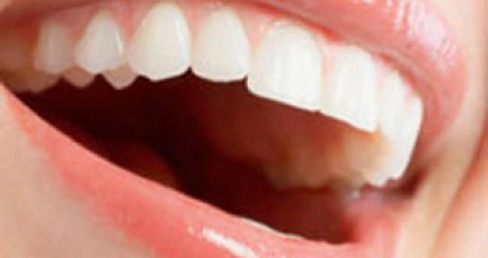 Ağız İçi Aft Nasıl Geçer?