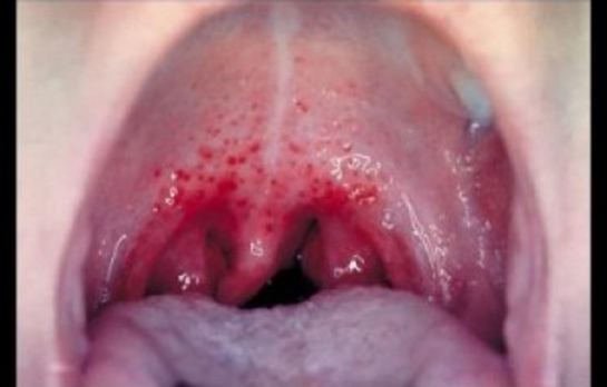 Damakta Aft Belirtileri ve Tedavisi