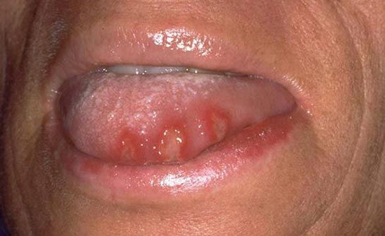 Dilde Aft Belirtileri ve Tedavisi